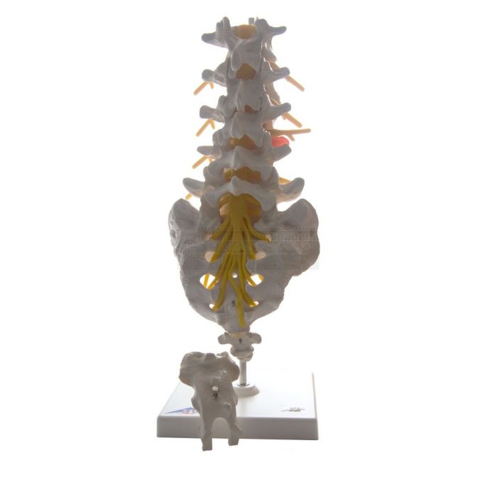 Lumbale wervelkolom met hernia 34 cm