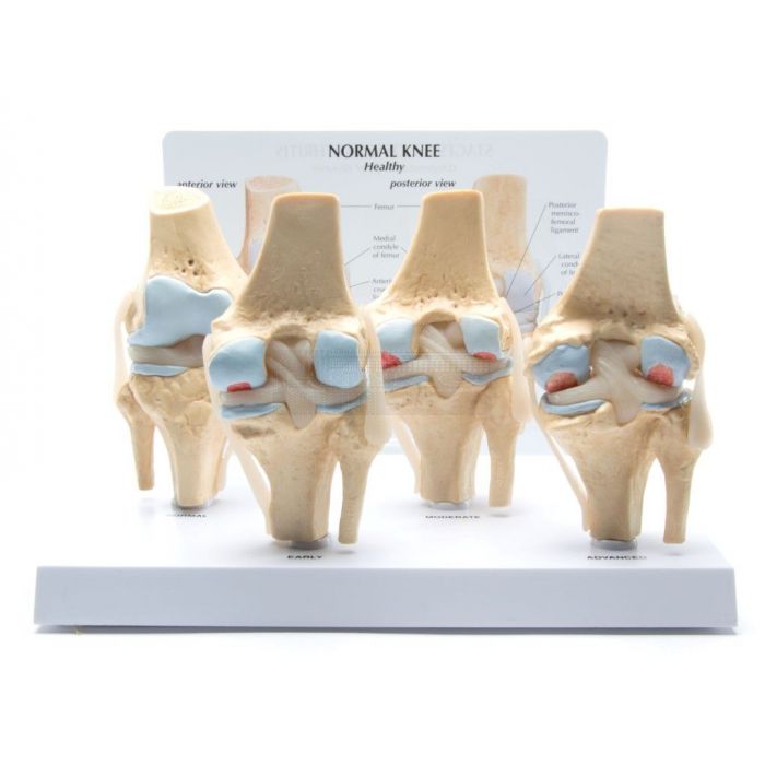 Knie, 4 stadia Osteoarthritis