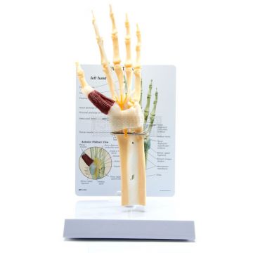 Hand - Pols met Carpaaltunnel syndroom en infokaart