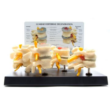 Ruggenwervels, 4 stadia op ware grootte