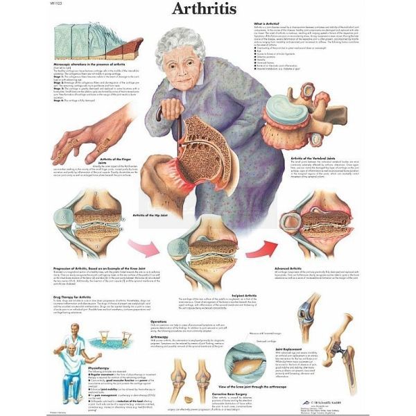 Anatomie poster Arthritis - artritis voorbeelden