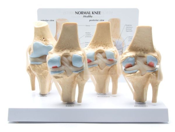 Knie, 4 stadia Osteoarthritis