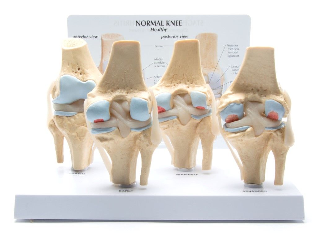 Anatomisch model van de knie, 4 stadia Osteoarthritis